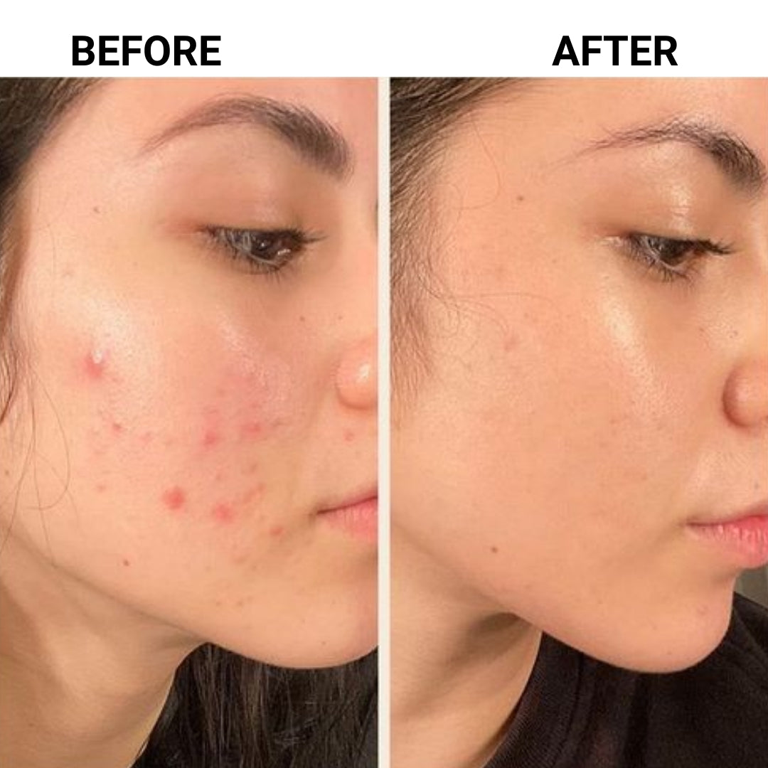 Glow Boosting Anti Acne Spot Gel | Healthy Skin : Ark Natural